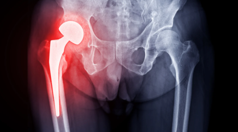 Esercizi in palestra dopo protesi d'anca: guida alla mobilità