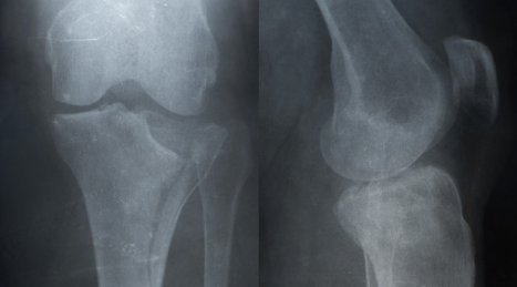 Tibia Fracture Recovery: Progressive Loading Protocol in the Gymnasium