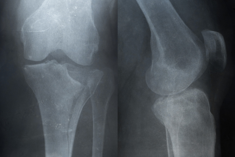 Tibia Fracture Recovery: Progressive Loading Protocol in the Gymnasium