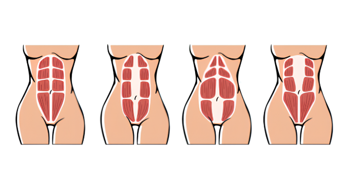 Pilates pour la diastasie des rectes : protocoles sûrs et progressifs